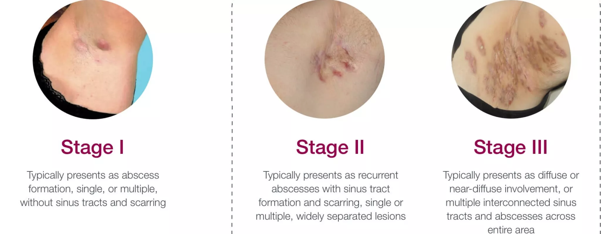 Hurley Stages of Hidradenitis Suppurativa 