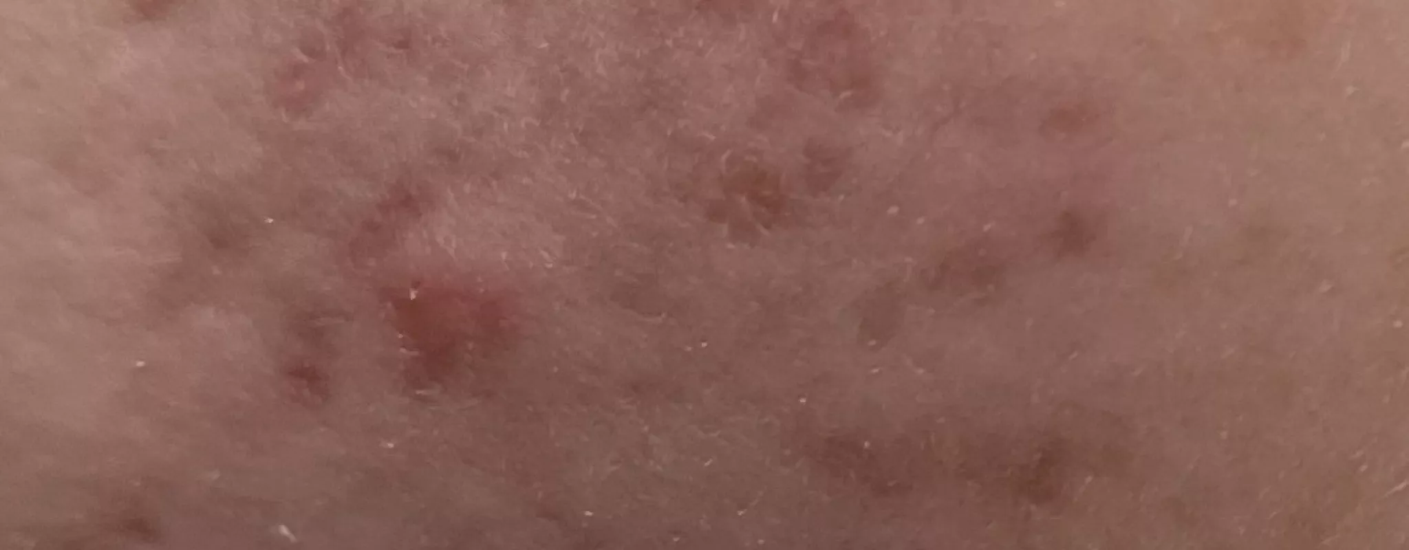 Emma's skin prior to treatment