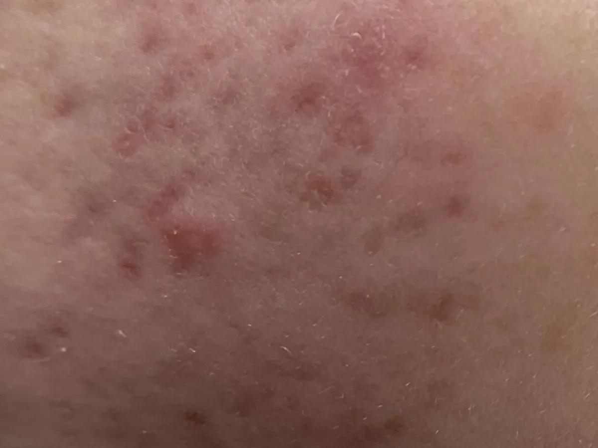 Emma's skin prior to treatment