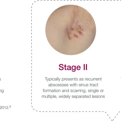 Hurley Stages of Hidradenitis Suppurativa 