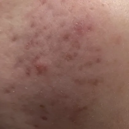 Emma's skin prior to treatment