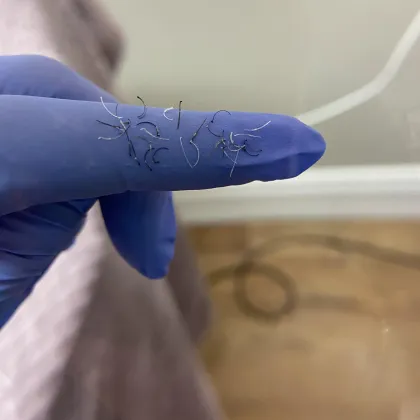 Hairs removed by electrolysis